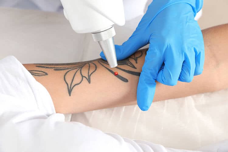 Tattoo removal